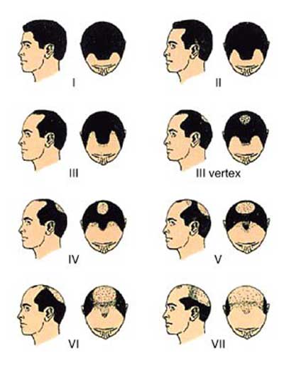 Men's Hair Loss Norwood Scale
