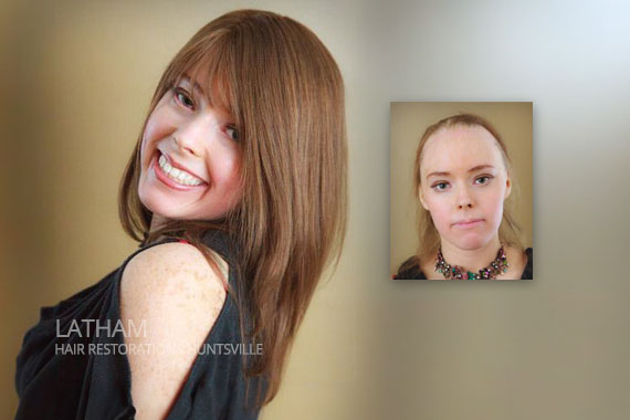 Julie Alopecia female hair loss solution huntsville alabama